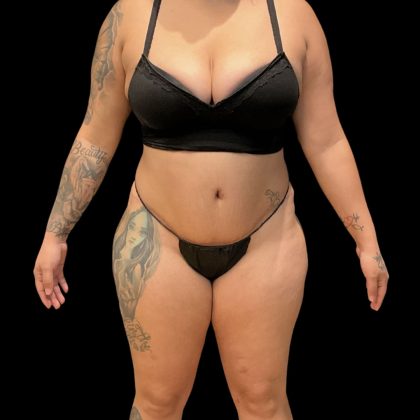 Brazilian Butt Lift Before & After Patient #10722