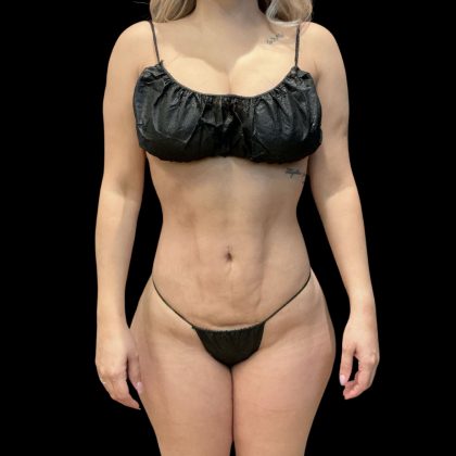 Brazilian Butt Lift Before & After Patient #10718