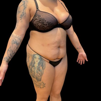 Brazilian Butt Lift Before & After Patient #10722