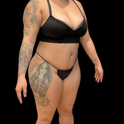 Brazilian Butt Lift Before & After Patient #10722
