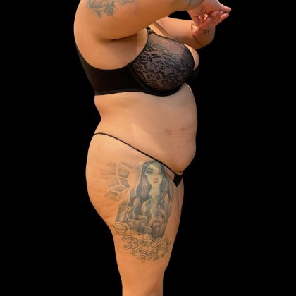 Brazilian Butt Lift Before & After Patient #10722