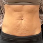 Vivace Before & After Patient #10849