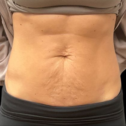 Vivace Before & After Patient #10849