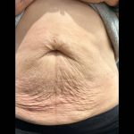 Morpheus8 Before & After Patient #10850
