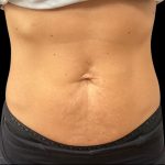 Vivace Before & After Patient #10849