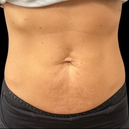 Vivace Before & After Patient #10849