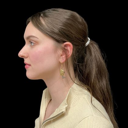 Rhinoplasty Before & After Patient #10847