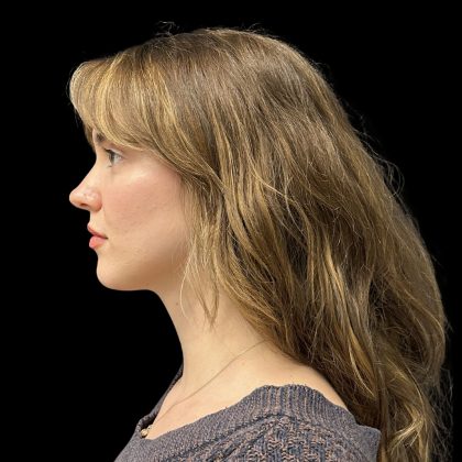 Rhinoplasty Before & After Patient #10847