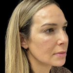 PRF EZ Gel Before & After Patient #10914