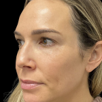PRF EZ Gel Before & After Patient #10914