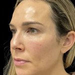PRF EZ Gel Before & After Patient #10914