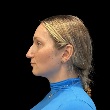 Rhinoplasty Before & After Patient #11186