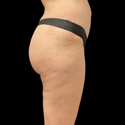 Auto Buttock Augmentation Before & After Patient #11188