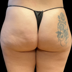 Alloclae Before & After Patient #11225