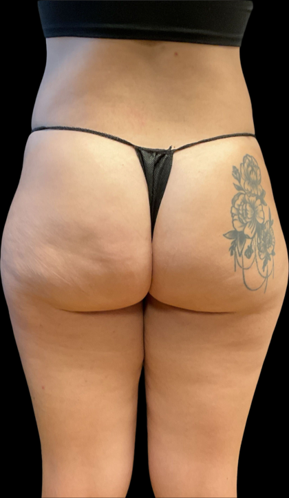 Alloclae Before & After Patient #11225