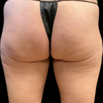 Alloclae Before & After Patient #11253