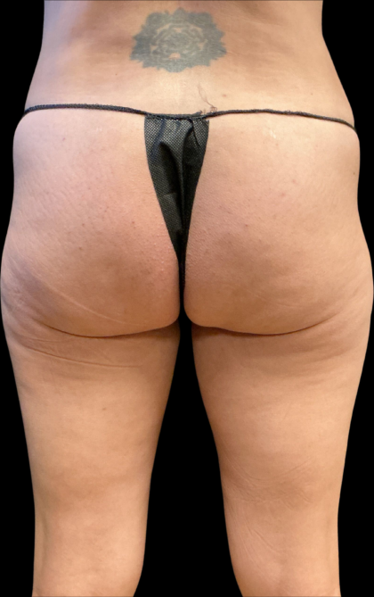 Alloclae Before & After Patient #11253