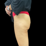 Auto Buttock Augmentation Before & After Patient #11188