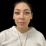 PRF EZ Gel Before & After Patient #11222