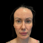 PRF EZ Gel Before & After Patient #11125