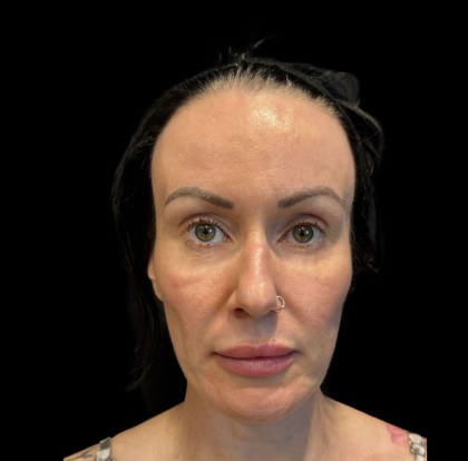 PRF EZ Gel Before & After Patient #11125