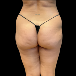 Brazilian Butt Lift Before & After Patient #11133