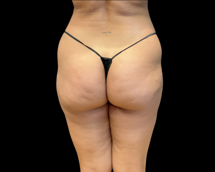 Brazilian Butt Lift Before & After Patient #11133