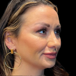 Sculptra Before & After Patient #11130