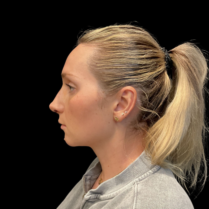 Rhinoplasty Before & After Patient #11186