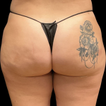 Alloclae Before & After Patient #11225
