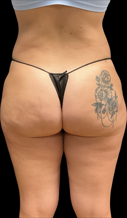 Alloclae Before & After Patient #11225