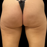 Alloclae Before & After Patient #11253