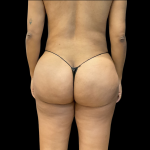 Brazilian Butt Lift Before & After Patient #11132