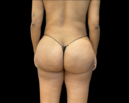 Brazilian Butt Lift Before & After Patient #11132