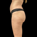 Auto Buttock Augmentation Before & After Patient #11188