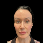PRF EZ Gel Before & After Patient #11125