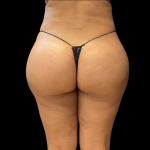 Brazilian Butt Lift Before & After Patient #11133