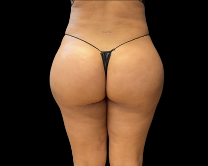 Brazilian Butt Lift Before & After Patient #11133