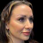 Sculptra Before & After Patient #11130
