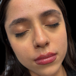 Lip Filler Before & After Patient #11224