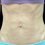 Sculptra Before & After Patient #11131