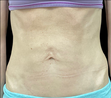 Sculptra Before & After Patient #11131