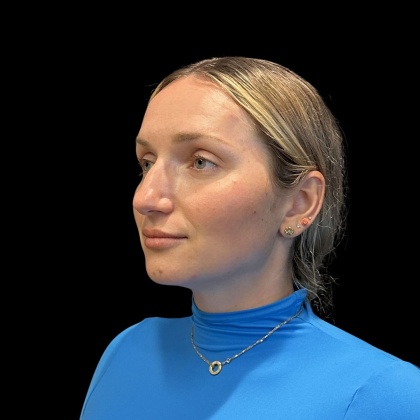 Rhinoplasty Before & After Patient #11186