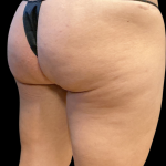 Alloclae Before & After Patient #11253
