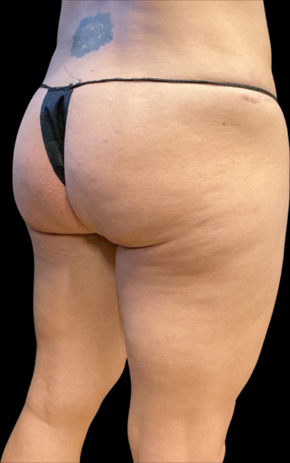 Alloclae Before & After Patient #11253