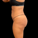 Brazilian Butt Lift Before & After Patient #11132