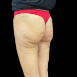 Auto Buttock Augmentation Before & After Patient #11188