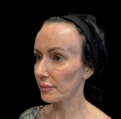 PRF EZ Gel Before & After Patient #11125