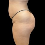 Brazilian Butt Lift Before & After Patient #11133