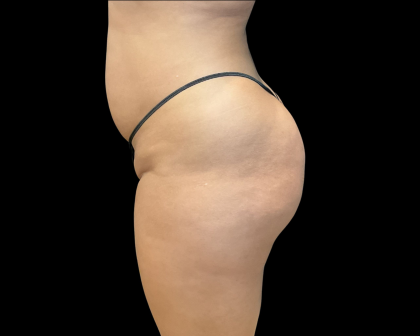 Brazilian Butt Lift Before & After Patient #11133